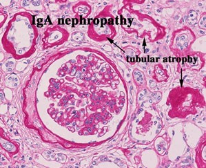 iga nephropathy basics